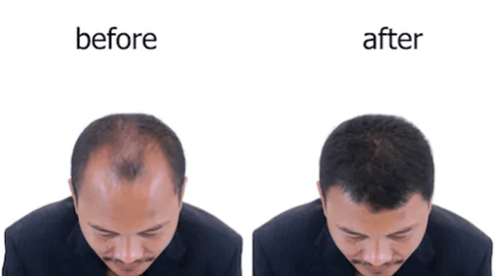 hair transplant